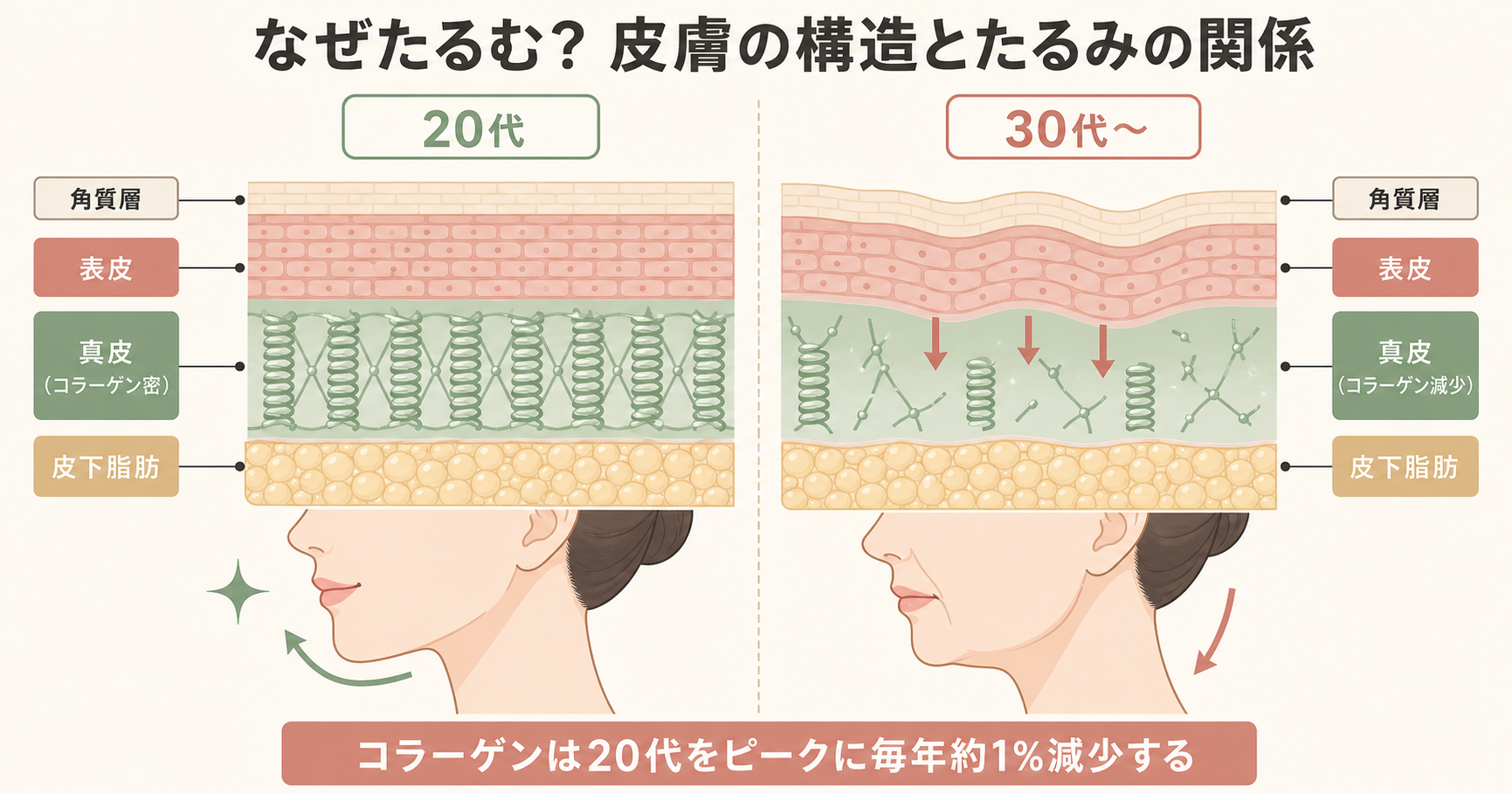 記事08_フェイスライン-たるみ-原因_画像8-2_皮膚断面図_たるみの仕組み.png