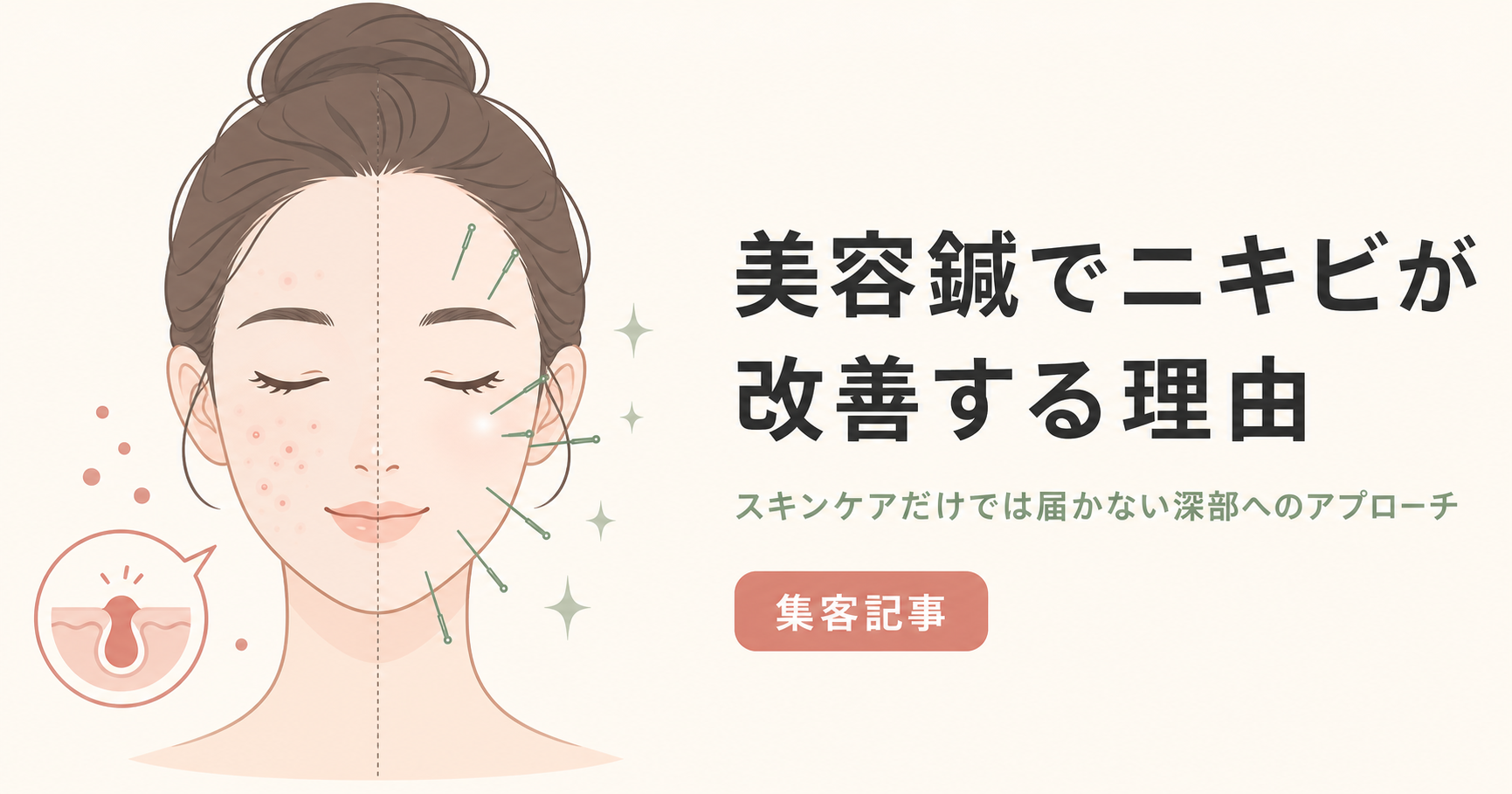記事30_美容鍼-ニキビ-効果